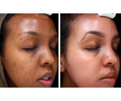 Acne Laser Treatment Cost In South Africa